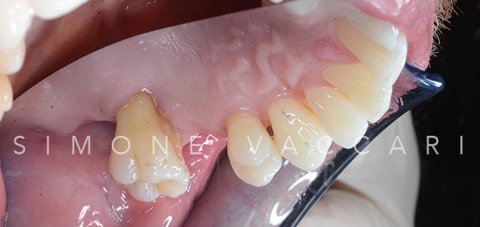 Michele dopo la cura della parodontite