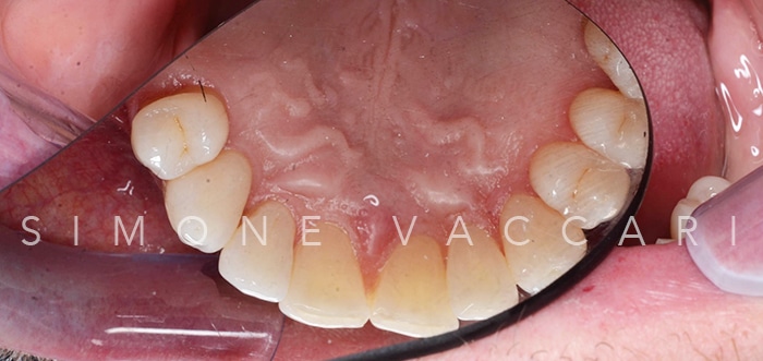 Michele arcata dopo la cura della parodontite