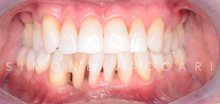 Michele bocca dopo la cura della parodontite