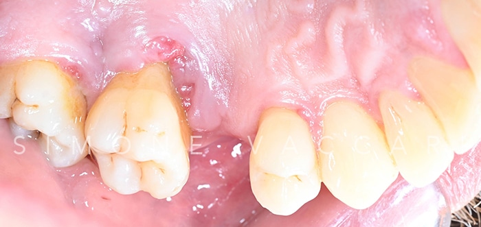 Michele prima della cura della parodontite