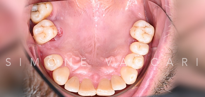 Michele arcata prima della cura della parodontite