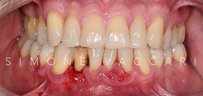 Michele bocca prima della cura della parodontite