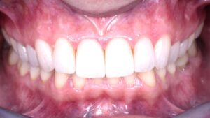 Erosione Dopo il trattamento