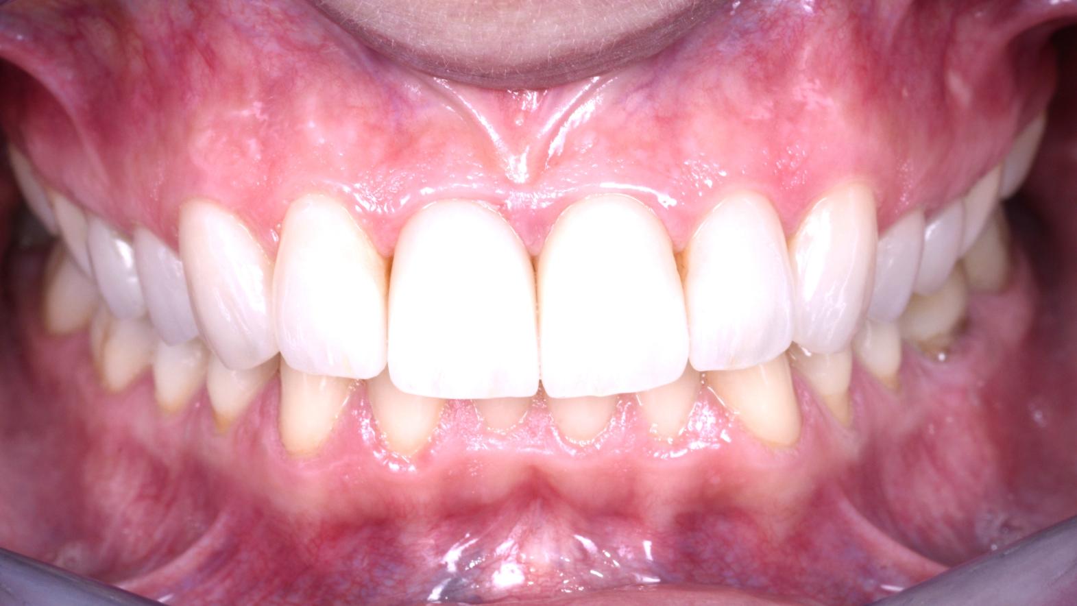 Erosione Dopo il trattamento