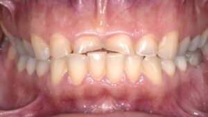 Danni erosione prima del trattamento