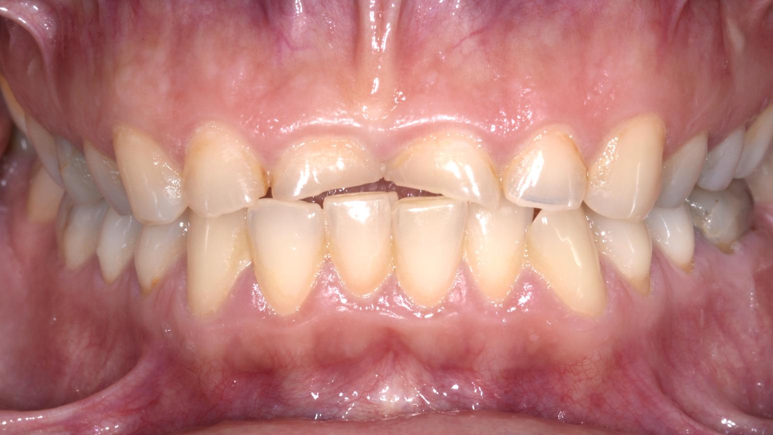 Danni erosione prima del trattamento