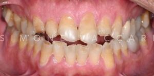 Esempio di reflusso gastro-esofageo