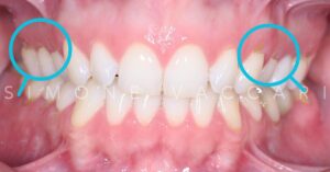 Esempio di abfrazione dentale