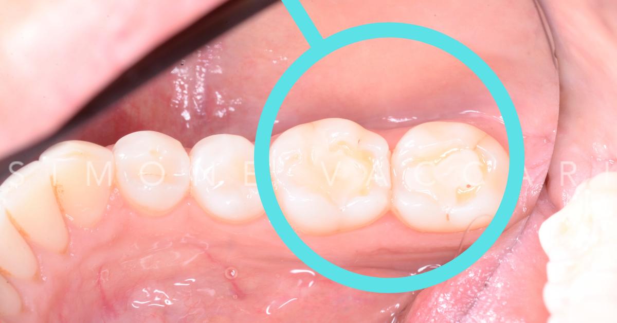 sui due molari è presente una otturazione bianca e attorno appara ampia area di erosione