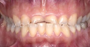 Esempio impatto vomito ripetuto (bulimia)