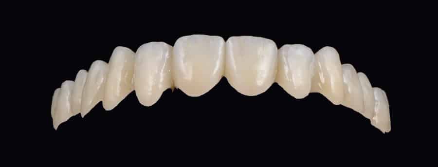 Corone in zirconia